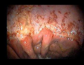 Gastric Ulcers back